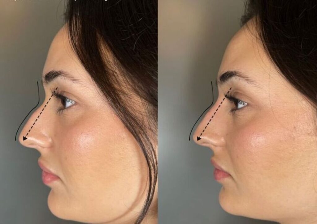 Revanesse Contour filler